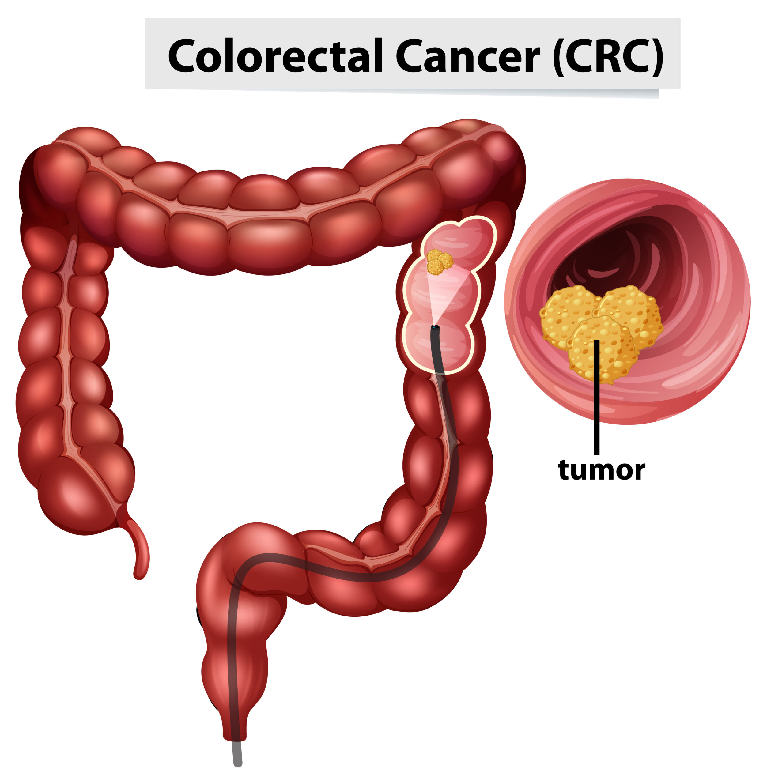 Tumore al colon