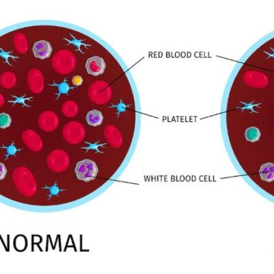 Anemia Emolitica Autoimmune: Sintomi, Cause e Trattamenti – Guida Completa per la Salute