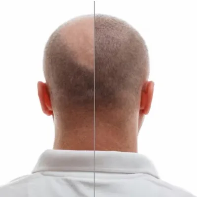 Alopecia: Consigli e Approcci per Mantenere una Salute dei Capelli Ottimale